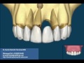 Dental Implant Verses Teeth Supported Fixed Teeth