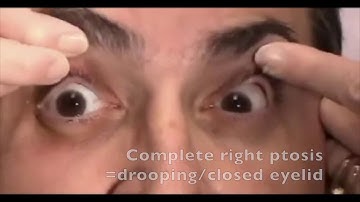 Reel-Example: Oculomotor (CNIII) Palsy (with parasympathetic fibers in tact)