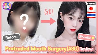 [EN/JP/TH/ SUB] Protruded Mouth Surgery (ASO) Review, Recovery Process 突出口手術 ผ่าตัดปากยื่น