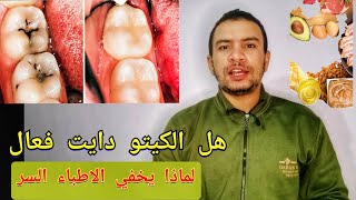 هل اتباع الكيتو دايت لمده شهر يعالج حقا تسوس الاسنان و انحسار اللثه؟ لماذا يخفي الاطباء ذلك؟