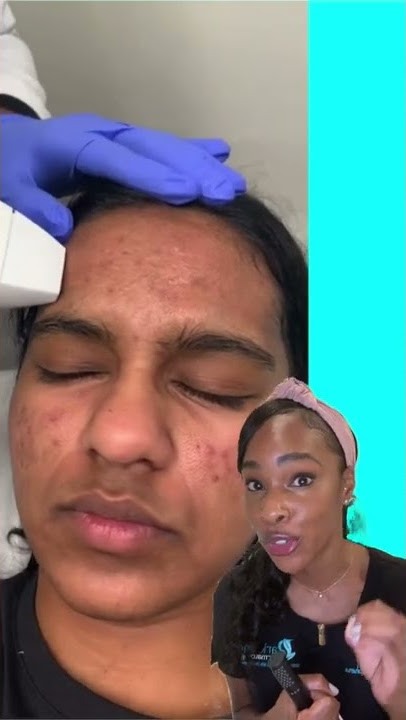 Don’t pop your pimples| prevent acne scars