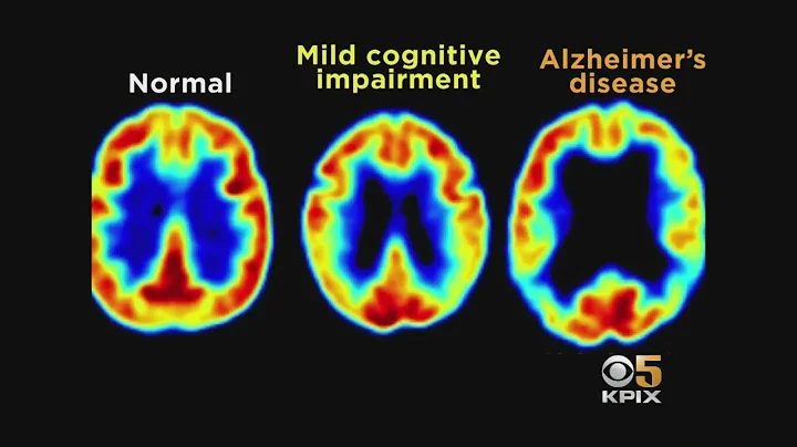 S.F. Researchers Find Fix for Gene Linked to Alzheimer's Disease