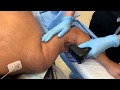 Morpheus8 skin remodeling and tightening  for the arms  west hollywood ca  dr jason emer