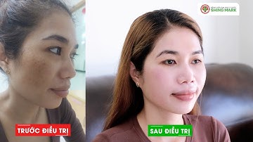 Điều trị thành công nám chân đinh sâu và lì | Bệnh viện Đại học Y Dược Shing Mark