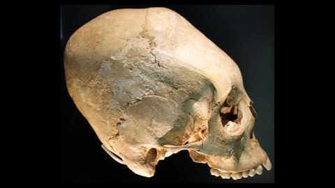 Artificial cranial deformation