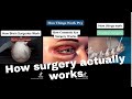 How surgery actually work
