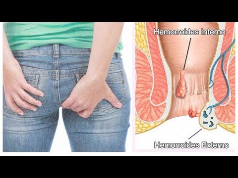 Banos de asiento para hemorroides con manzanilla