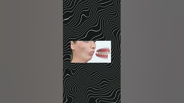 Khớp cắn sâu là gì? Tác hại của khớp cắn sâu bạn không nên bỏ qua!!