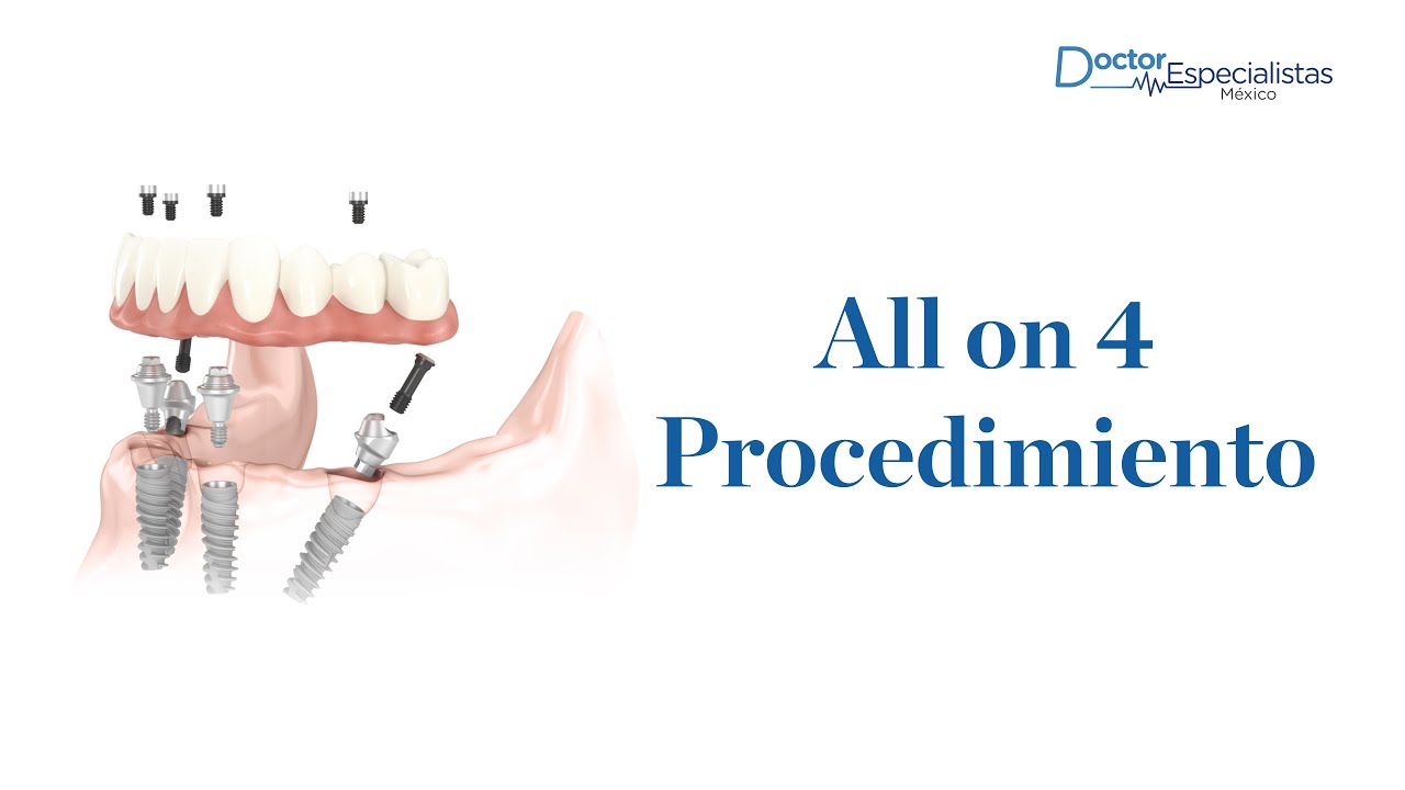 All on 4 procedimiento - Doctores Especialistas