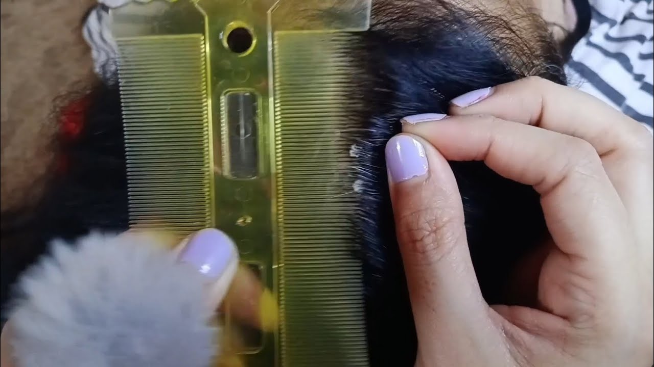 ASMR: Check The Scalp For Dandruff
