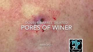 Double Barrel Blackheads Dilated Pores Of Winer. Blackhead Pop. Big Squeeze. Cyst Excision. Cyst Pop