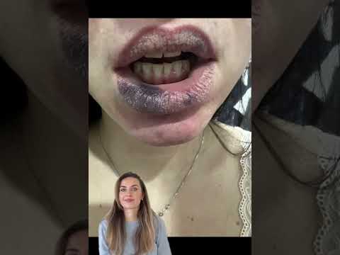 Осложнение после увеличения губ. Так ли безобидны уколы? #губы #увеличениегуб #косметология