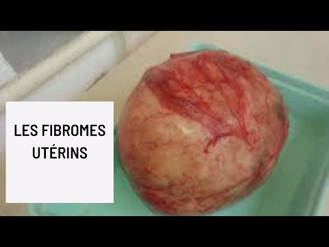 Vidéo: Symptômes des fibromes utérins