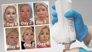 Download Lagu Halo Laser: Niet alleen voor beroemdheden - Herstel na dag MP3