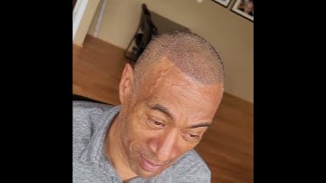 Scalp Micropigmentation After His 1st Session