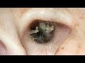 #162 〜好評につき【耳カメラ動画】1本通常公開(4月編)//耳掃除後◯日⁉️〜 earwax