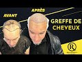 Greffe de cheveux  lhistoire dun patient  renaissance clinique