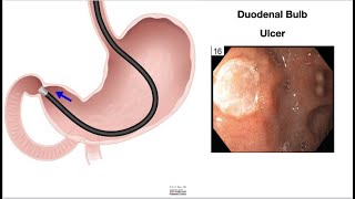 HCC 1475-6-Small Intestine Pathology Endoscopy Findings