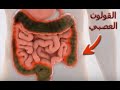 أمراض الجهاز الهضمي علاج القولون العصبي 