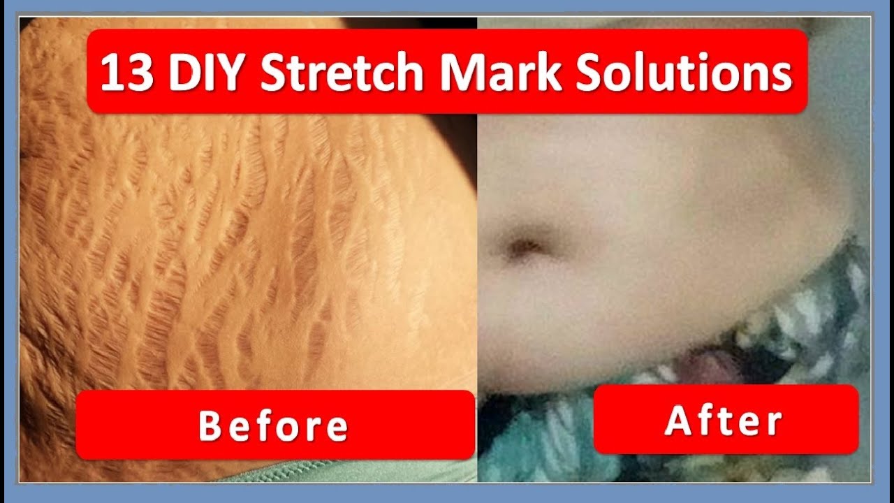 13 Diy Stretch Mark Solutions 13 Home Remedies For Stretch Marks