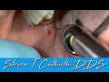 Painless and Profound Mandibular Block - Dental Minute with Steven T. Cutbirth, DDS