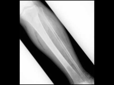 gangrene-of-the-foot-with-soft-tissue-gas-on-x-ray