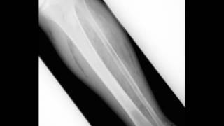 Gangrene of the Foot with Soft Tissue Gas on X ray screenshot 3