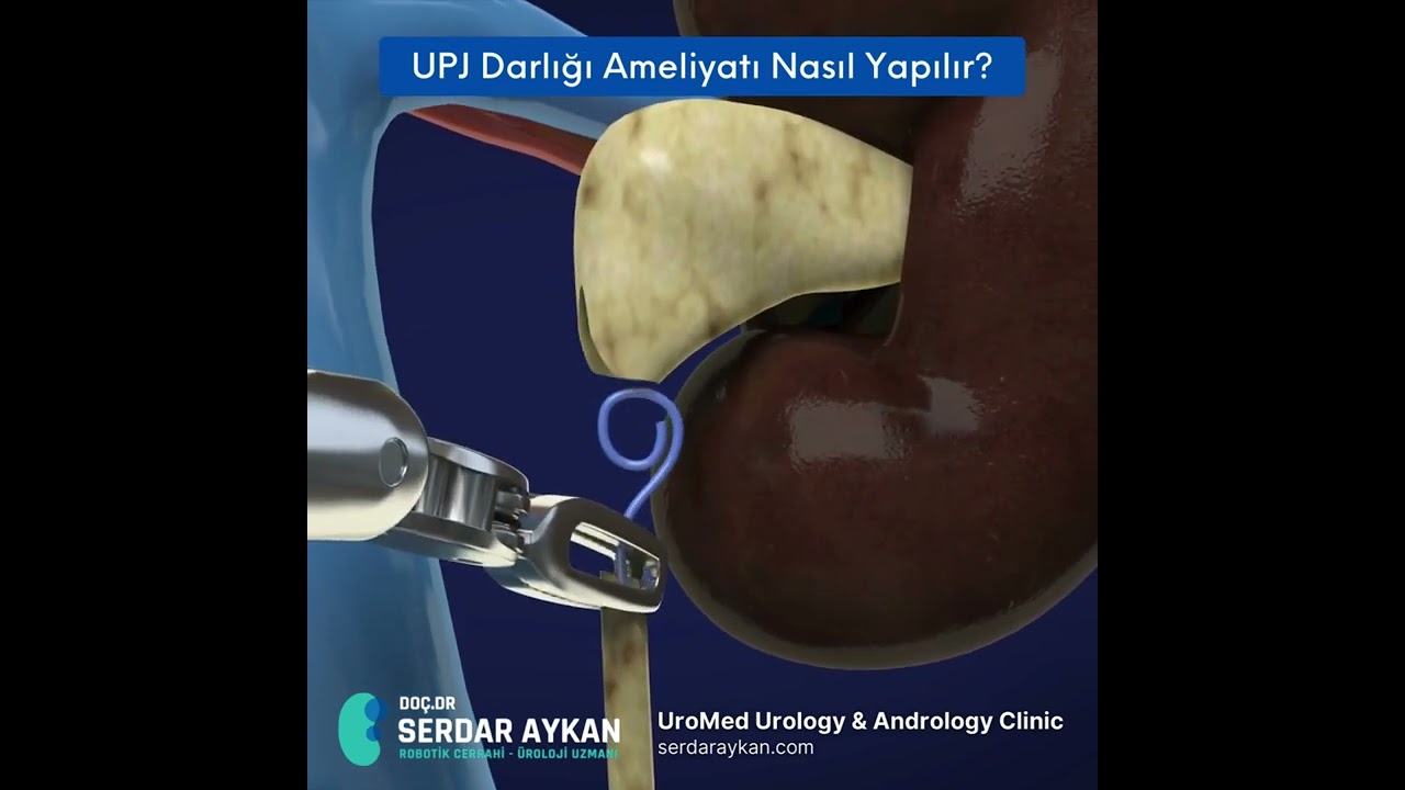 UPJ DARLIK VE OPERASYONU. DOC DR SERDAR AYKAN