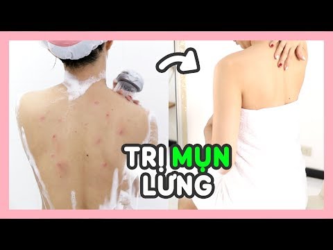 5 SAI LẦM PHỔ BIẾN KHI TRỊ MỤN LƯNG ??
