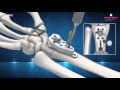 Distal Radius Plate VISIOFIX Concept & Surgical Technique 3D Animation