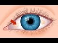 What are the ugly yellow spots in my eye  an optometrist explains  true eye experts
