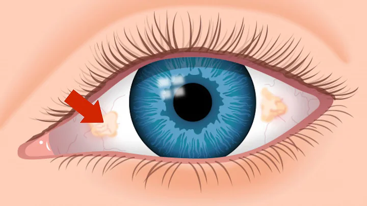 What Are The Ugly Yellow Spots In My Eye? | An Optometrist Explains | True Eye Experts
