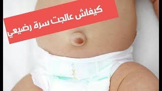 علاج خروج سرة الرضيع هكيفاش عالجتها بسهولة في سبعة أيام