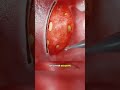 Tonsillectomy!! 😱(3D Animation) #tonsillectomy#tonsillitis#tonsilsremoval#tonsilremoval#tonsillitis