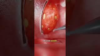 Tonsillectomy!! 😱(3D Animation) #tonsillectomy#tonsillitis#tonsilsremoval#tonsilremoval#tonsillitis