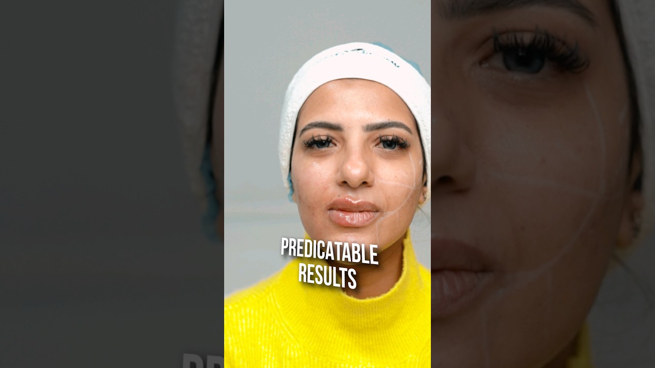 Correct Facial Volume Loss | Croma Saypha Fillers 