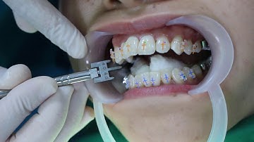 MẮC CÀI PHA LÊ - CÓ THỂ BẠN CHƯA BIẾT