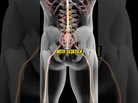 Video: Cum să remediați durerea sciatică rea: 13 pași (cu imagini)