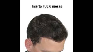 Caso real de Injerto Capilar
