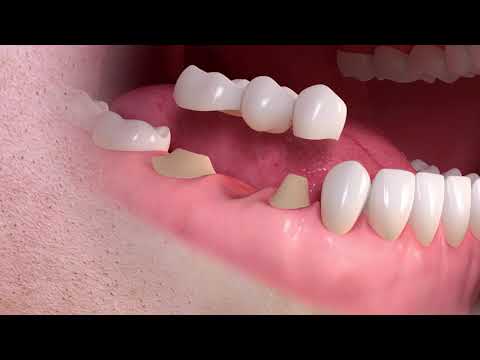 straumann conventional 3