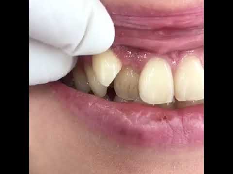 湘南美容歯科福岡院 セラミック矯正 その日に変わるone Dayスピードセラミック 仮歯 ダイヤモンドセラミック ファイナル Youtube