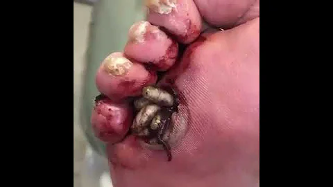 Терапевтические опарыши на диабетической ноге🐛