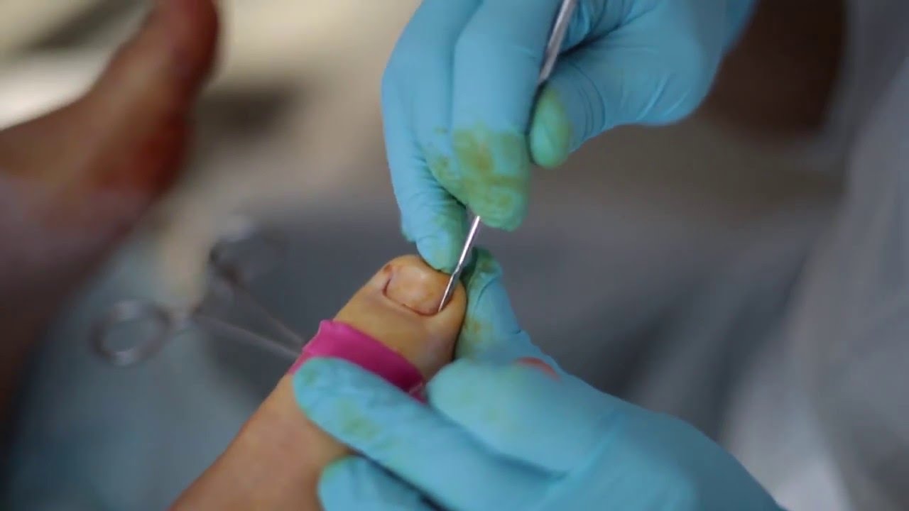 A new modification of the Winograd technique for the treatment of ingrown  toenail