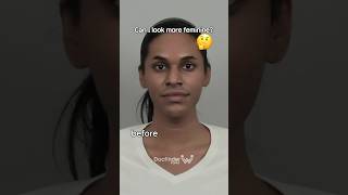 Loving The Result Of Facial Feminization Surgery In Korea