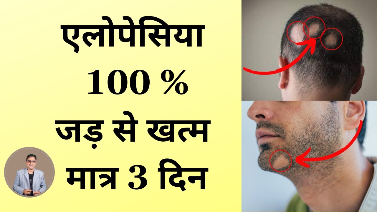 alopecia areata natural treatment | balchar ka ilaj - YouTube