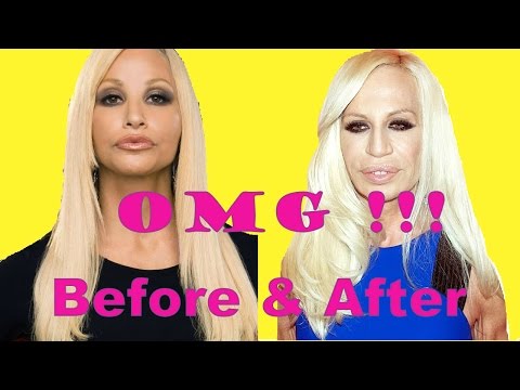 Donatella Versace Plastic Surgery Before and After