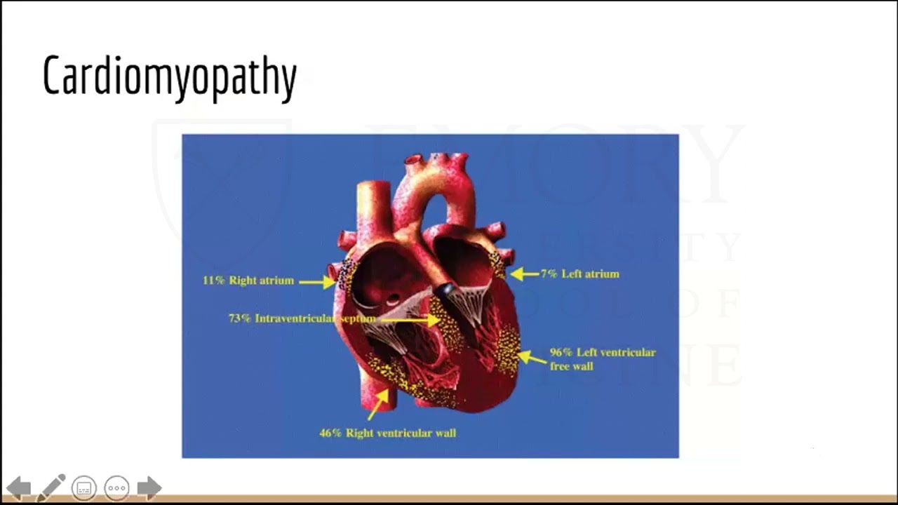 Cardiac Sarcoidosis