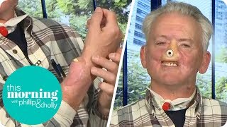 A Grizzly Bear Ripped My Face Off and Now I'm Regrowing My Nose on My Arm | This Morning