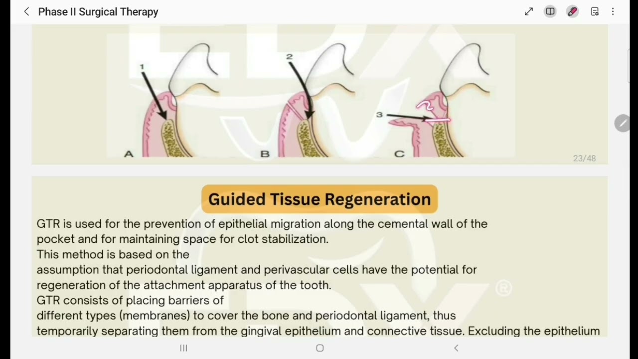بريو مرحلة رابعه محاضرة Phase II Surgical Therapy الجزء الثاني