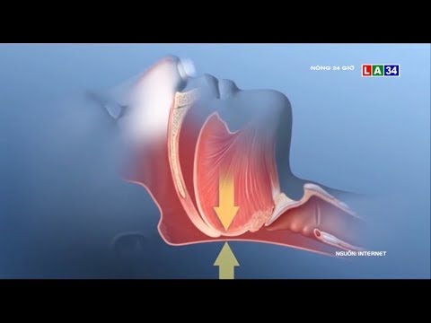 Video: Cách Ngừng Ngáy Bằng Cách Dùng Ống Miệng Chống Ngáy